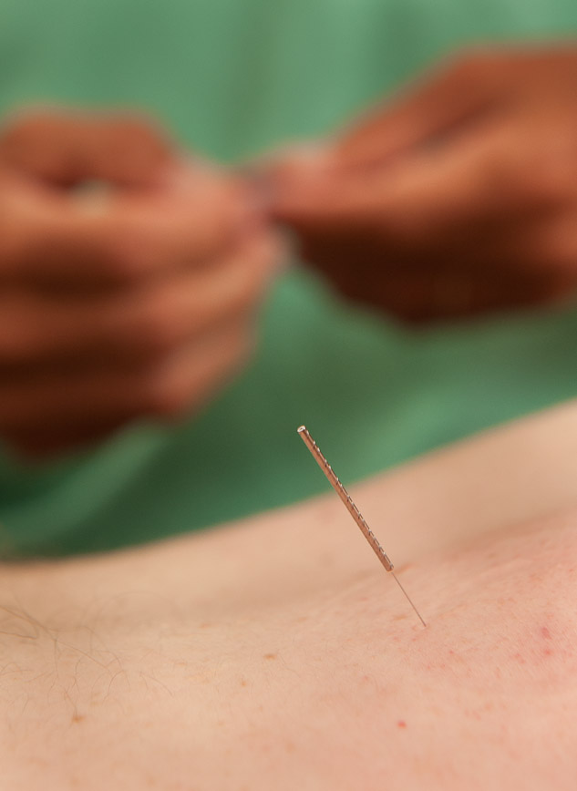 Acupuncture needle during treatment