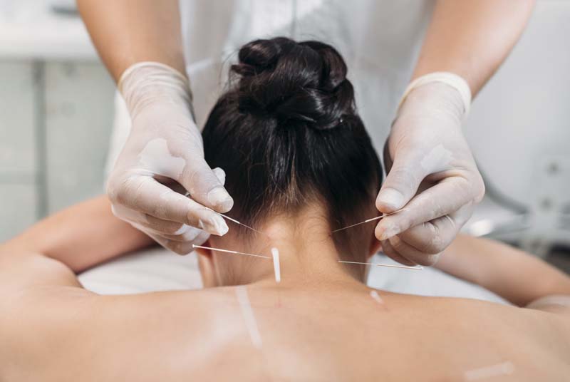 patients receives acupuncture for migraine headache treatment