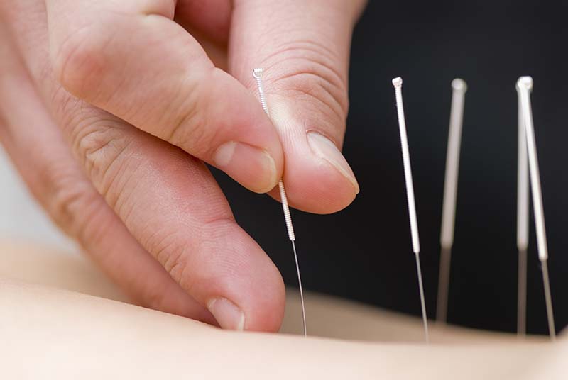 acupuncture needles being inserted into a patients back, close-up