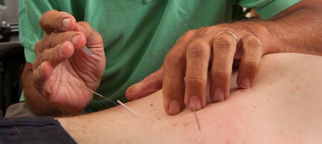 dr. Schram performing acupuncture for back pain in lower back